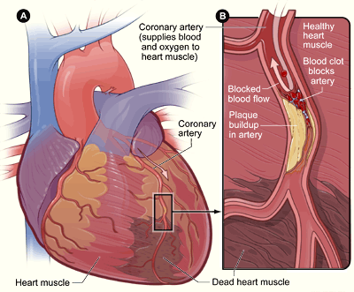 heart disease