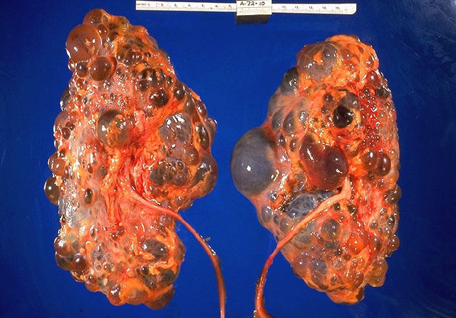 Kidney Disease