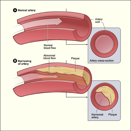 atherosclerosis