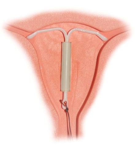 IUD